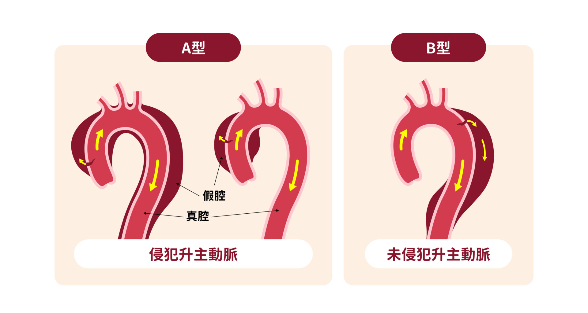 急性主動脈剝離手術 - 大林慈濟心臟血管外科