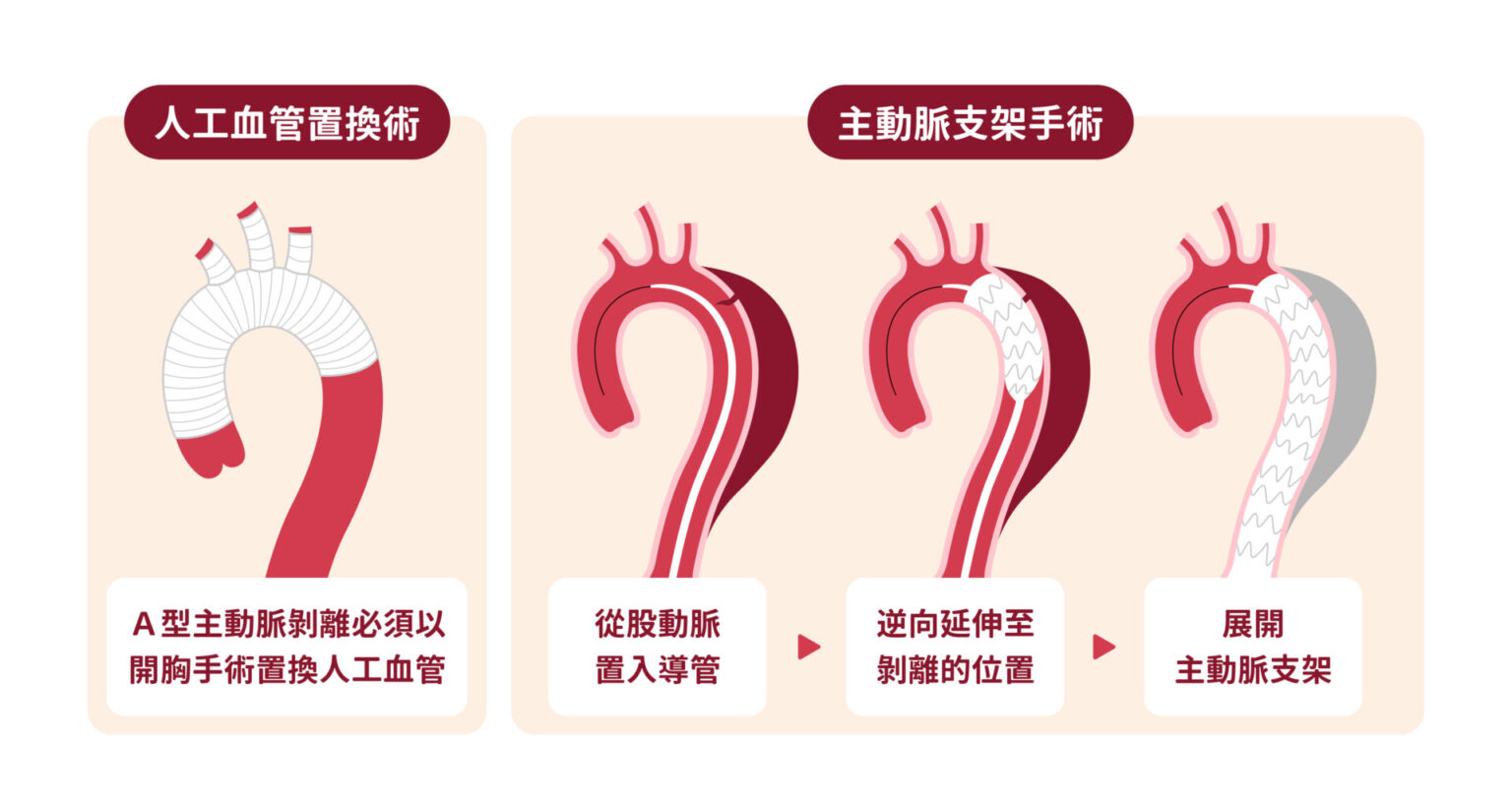 主動脈剝離 - 大林慈濟心臟血管外科
